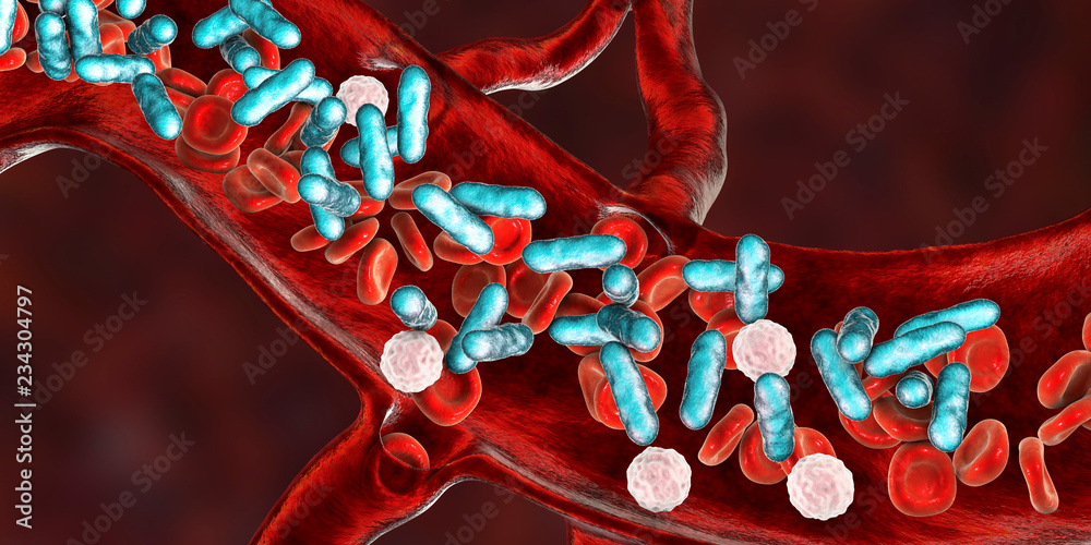 Sepsis image 2